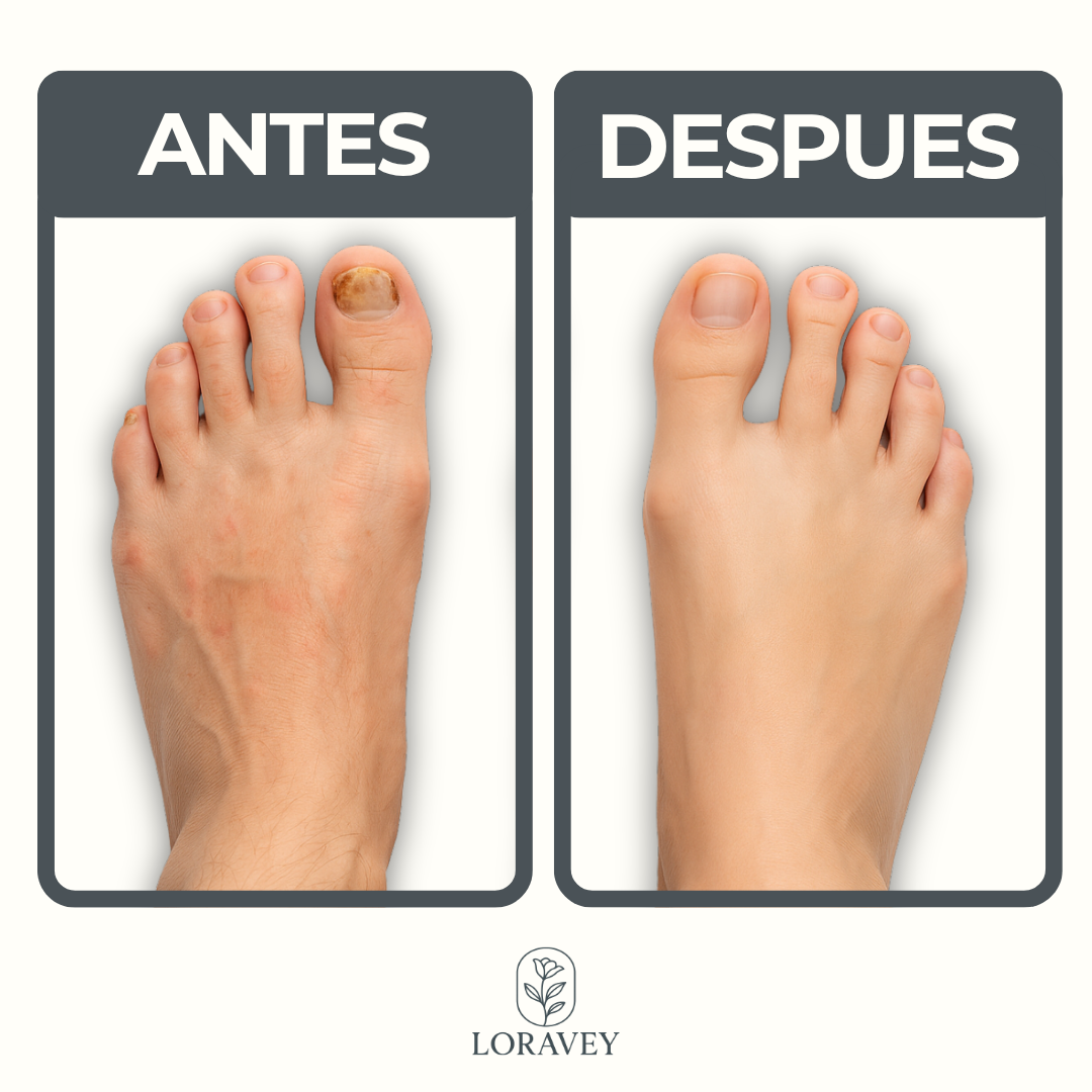 LORAVEY | ACEITE ANTIFUNGICO